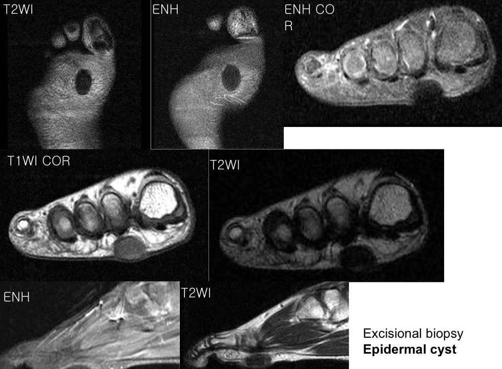 Figure 2 for case epidermoid cyst ( RID3908 )
